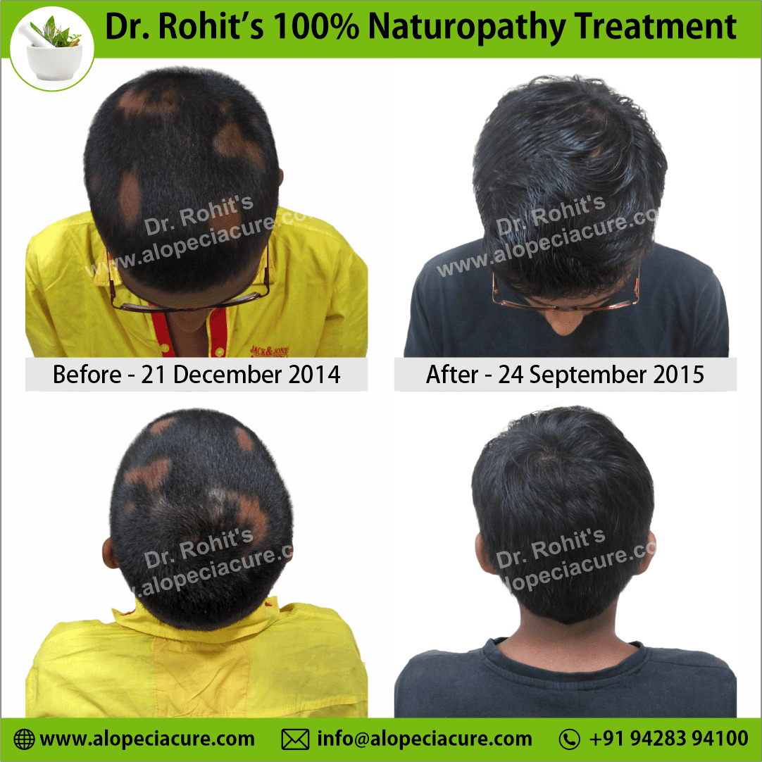 Ophiasis Alopecia Areata Clinical Result