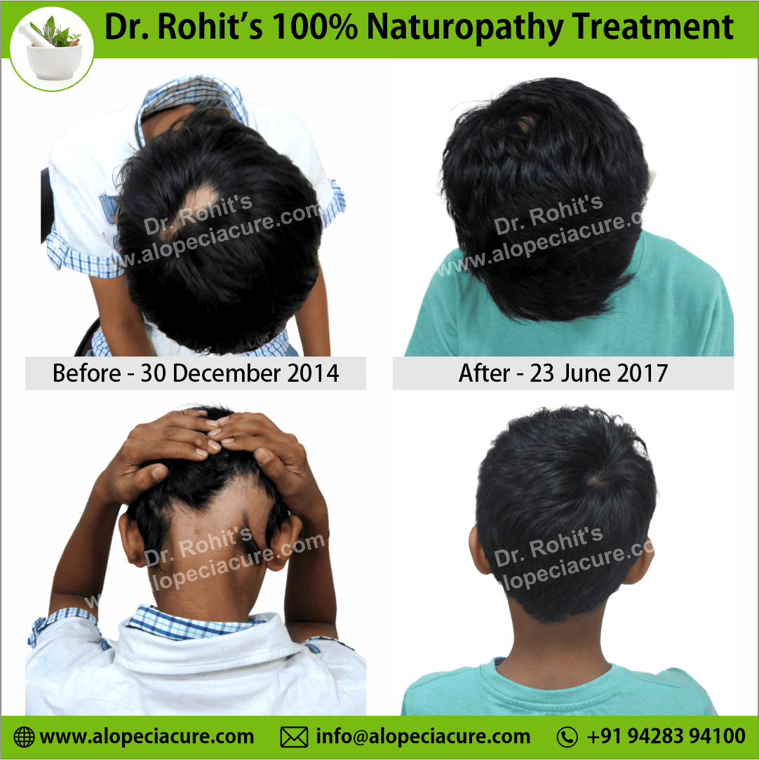 Ophiasis Alopecia Areata Clinical Result