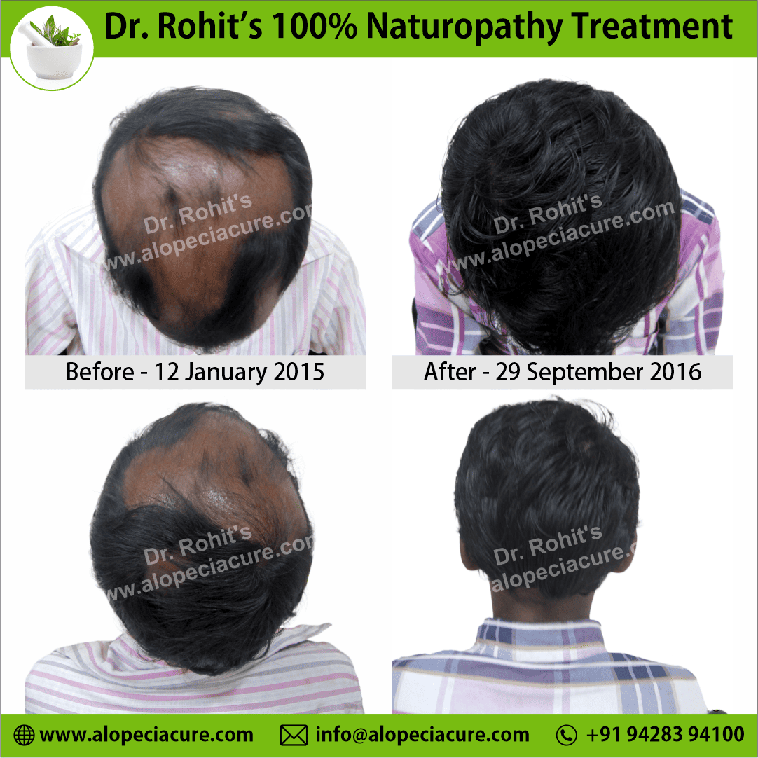 Ophiasis Alopecia Areata Clinical Result