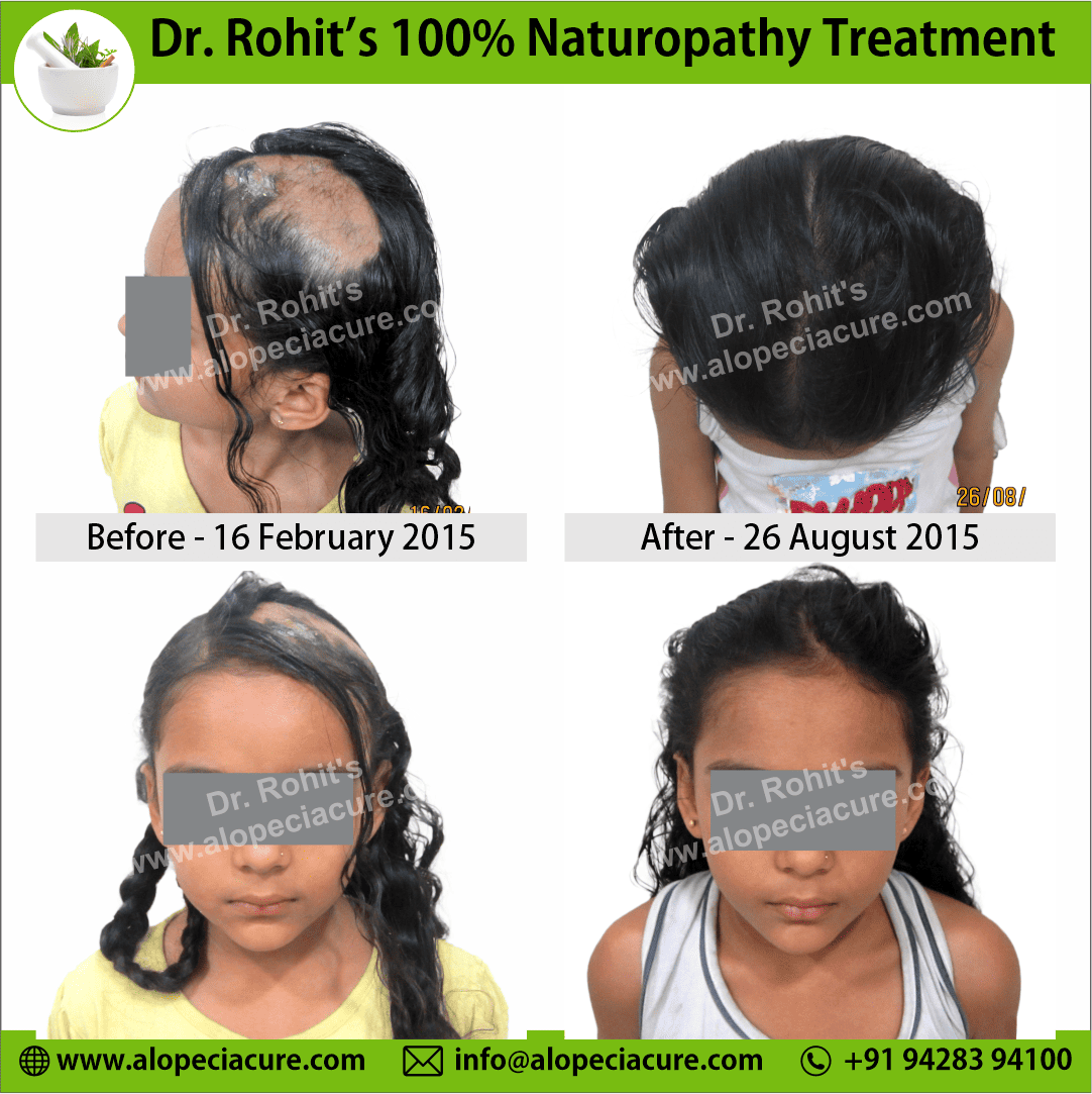 Ophiasis Alopecia Areata Clinical Result