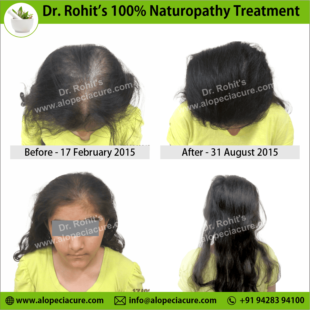Ophiasis Alopecia Areata Clinical Result