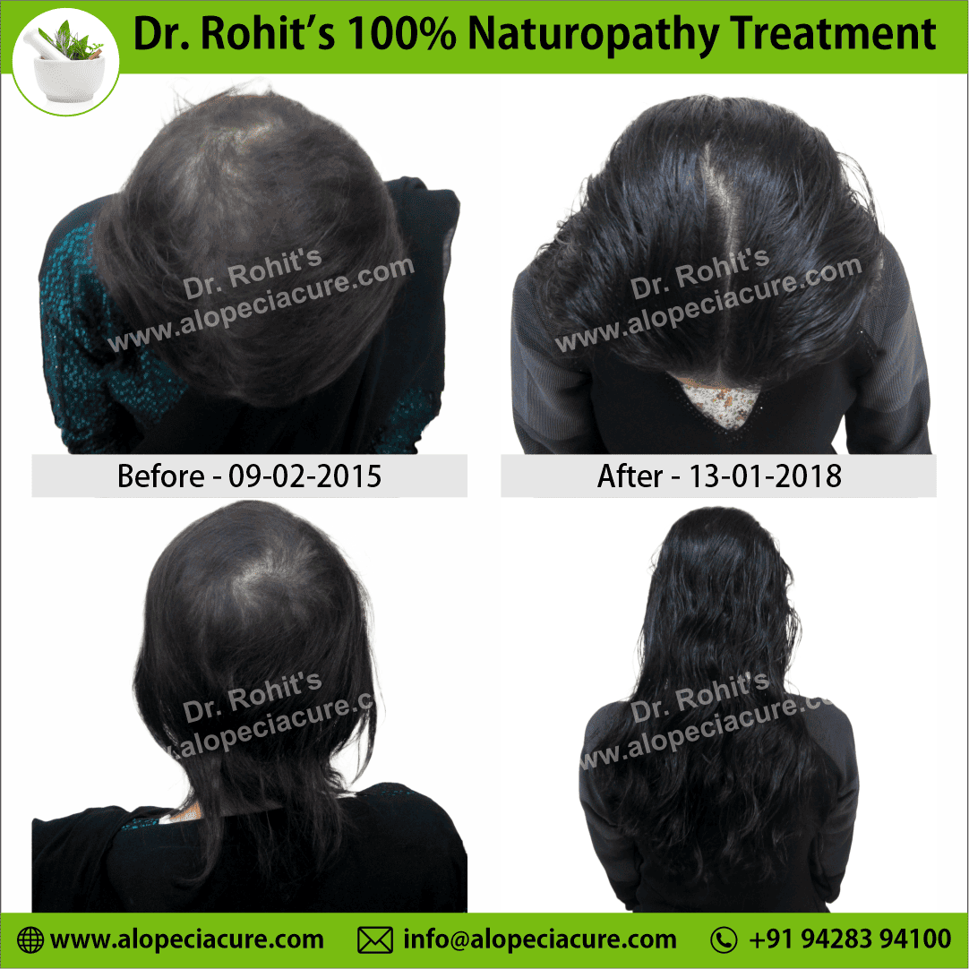 Ophiasis Alopecia Areata Clinical Result