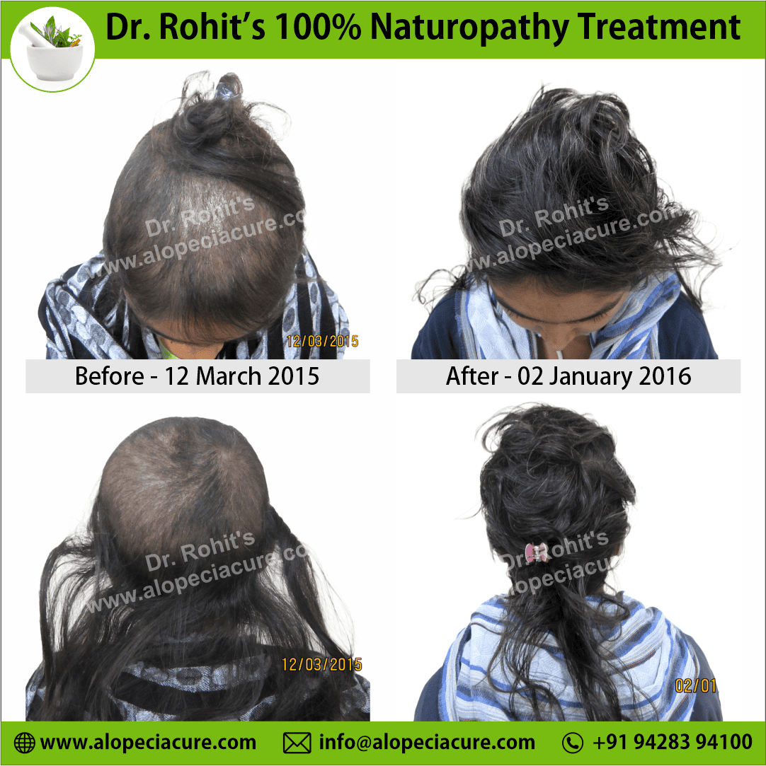 Ophiasis Alopecia Areata Clinical Result