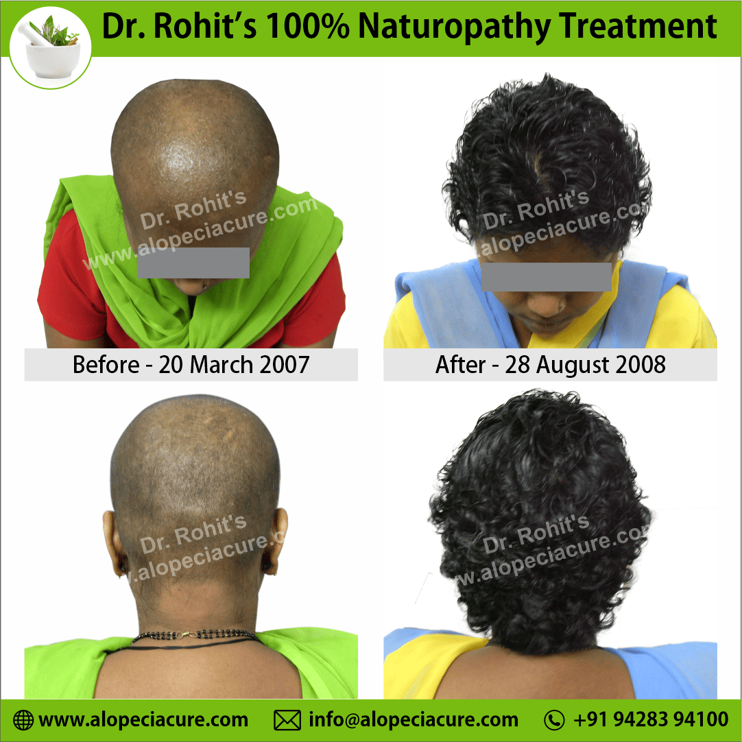 Ophiasis Alopecia Areata Clinical Result