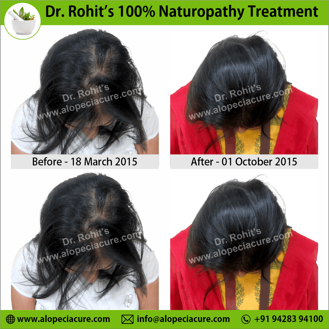 Ophiasis Alopecia Areata Clinical Result