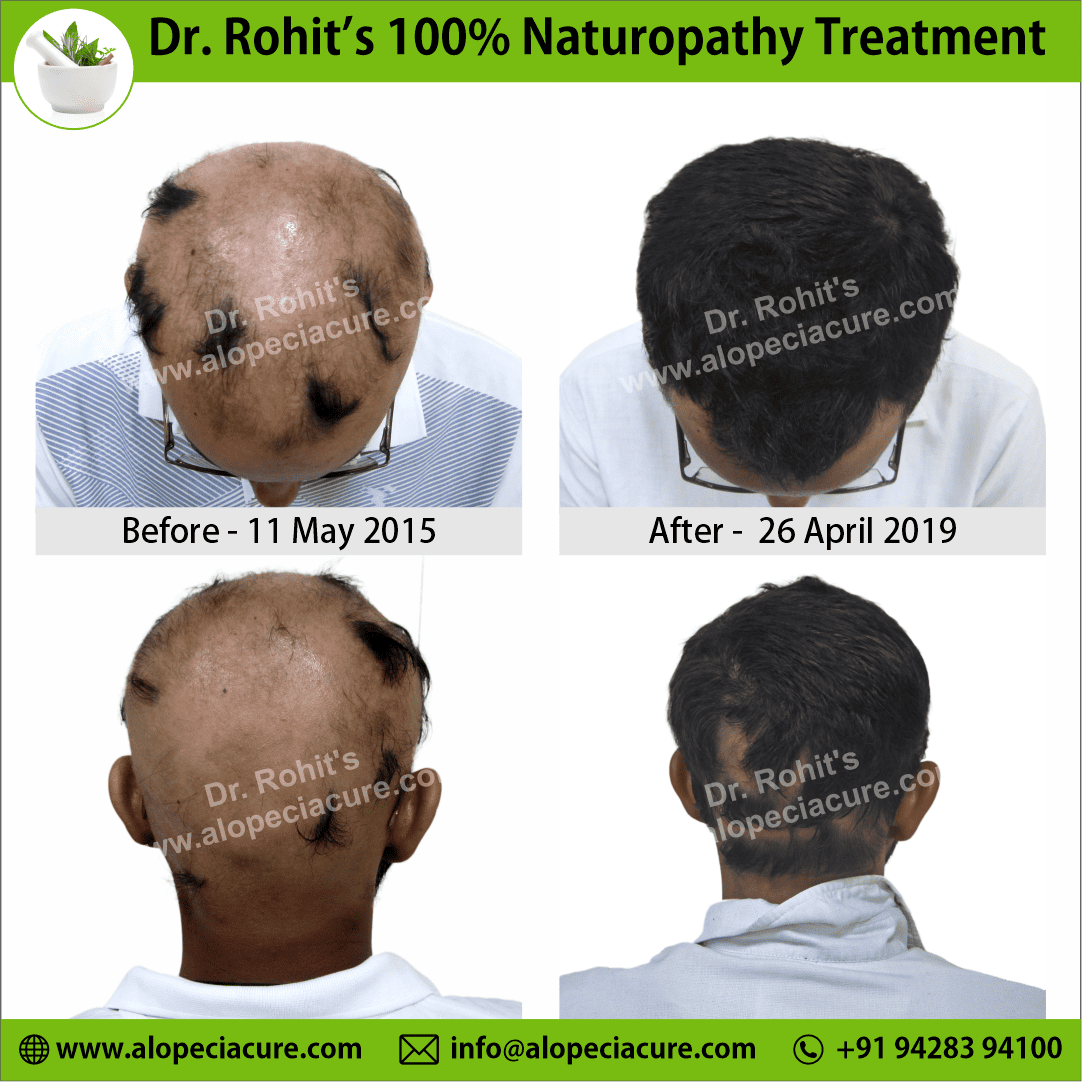 Ophiasis Alopecia Areata Clinical Result