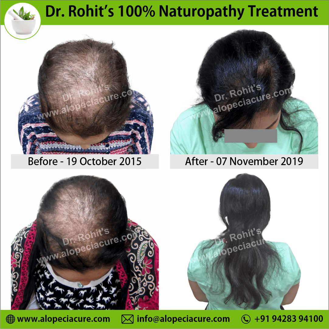 Ophiasis Alopecia Areata Clinical Result