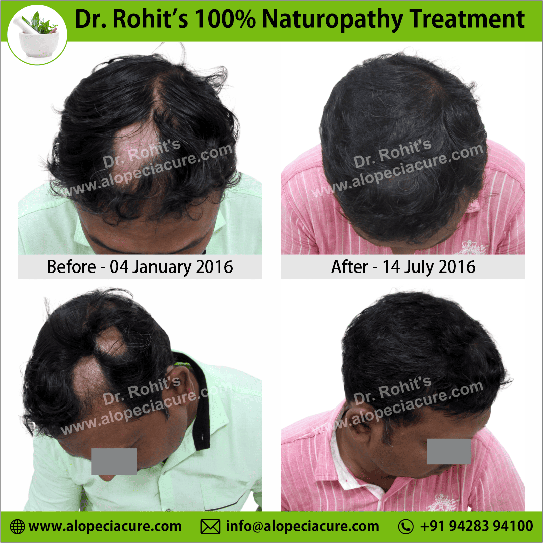 Ophiasis Alopecia Areata Clinical Result