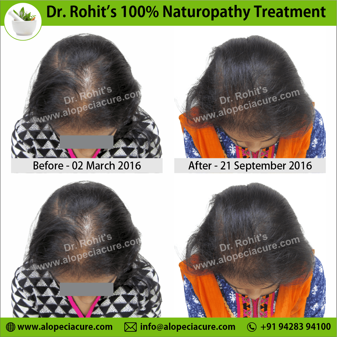 Ophiasis Alopecia Areata Clinical Result