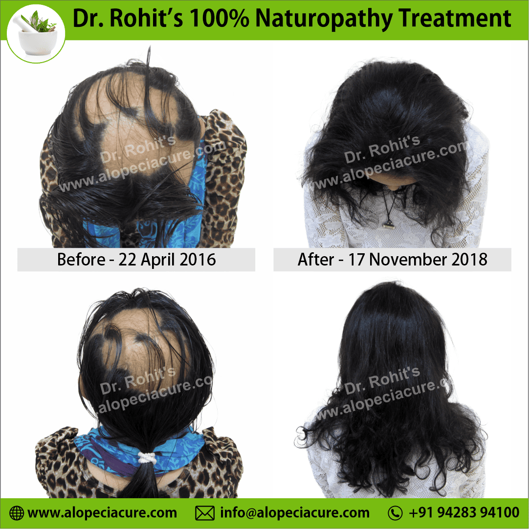 Ophiasis Alopecia Areata Clinical Result