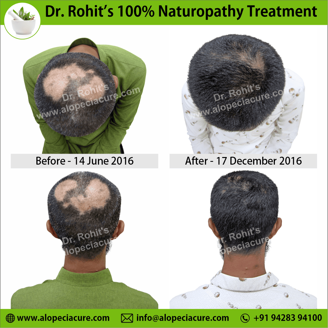 Ophiasis Alopecia Areata Clinical Result