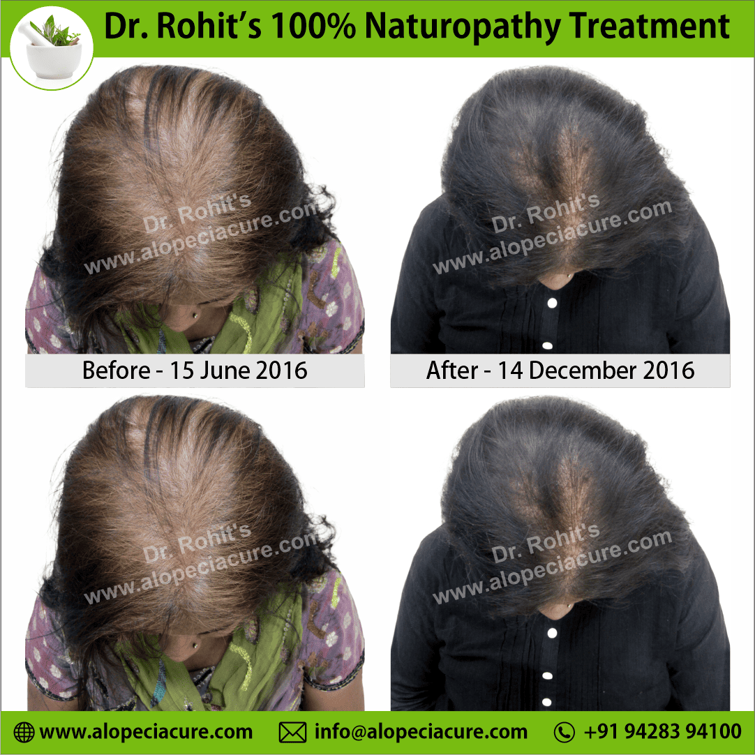 Ophiasis Alopecia Areata Clinical Result