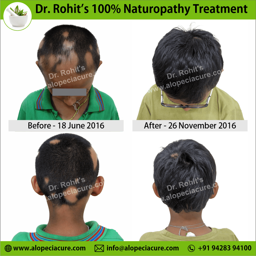 Ophiasis Alopecia Areata Clinical Result
