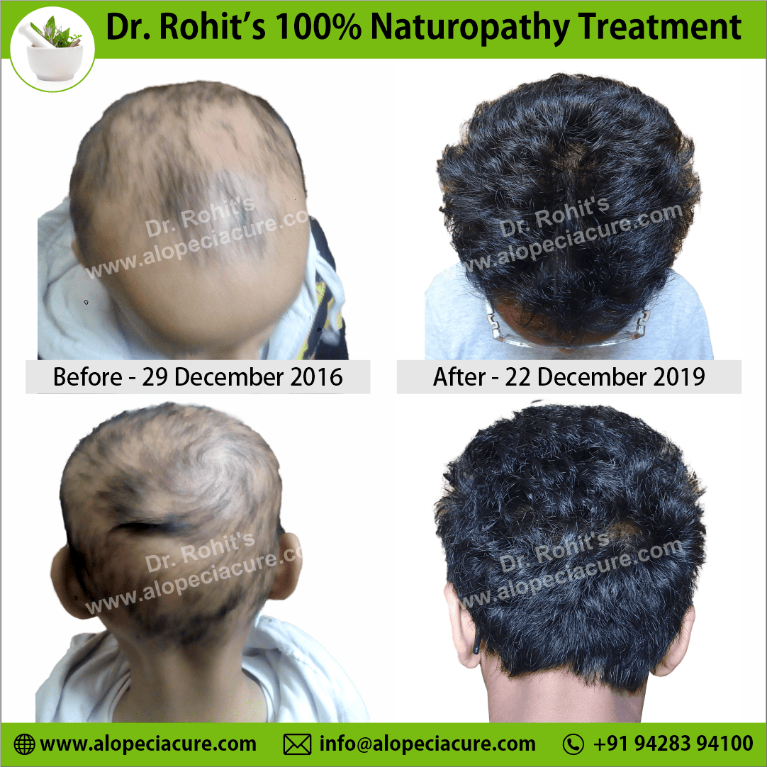 Ophiasis Alopecia Areata Clinical Result