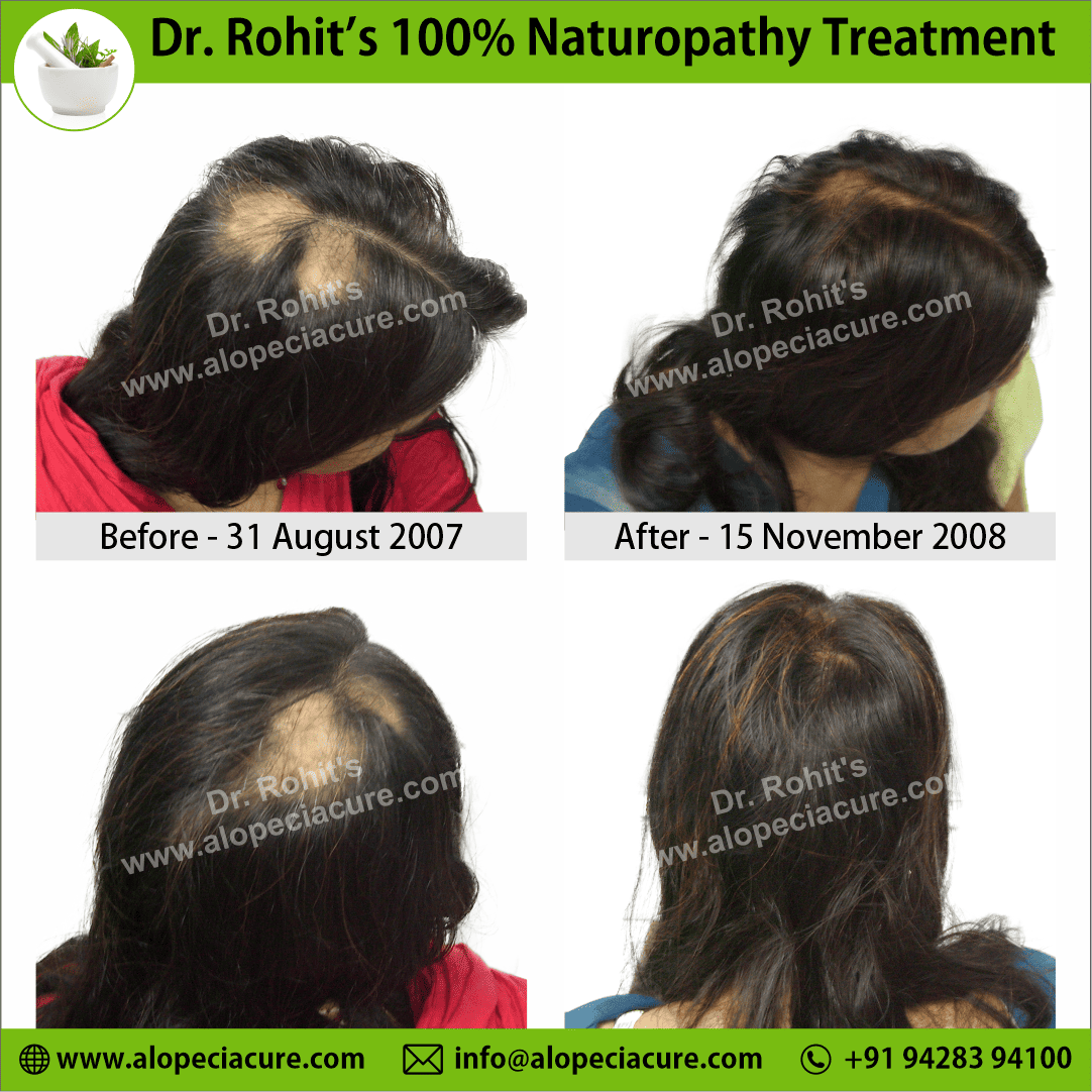 Ophiasis Alopecia Areata Clinical Result