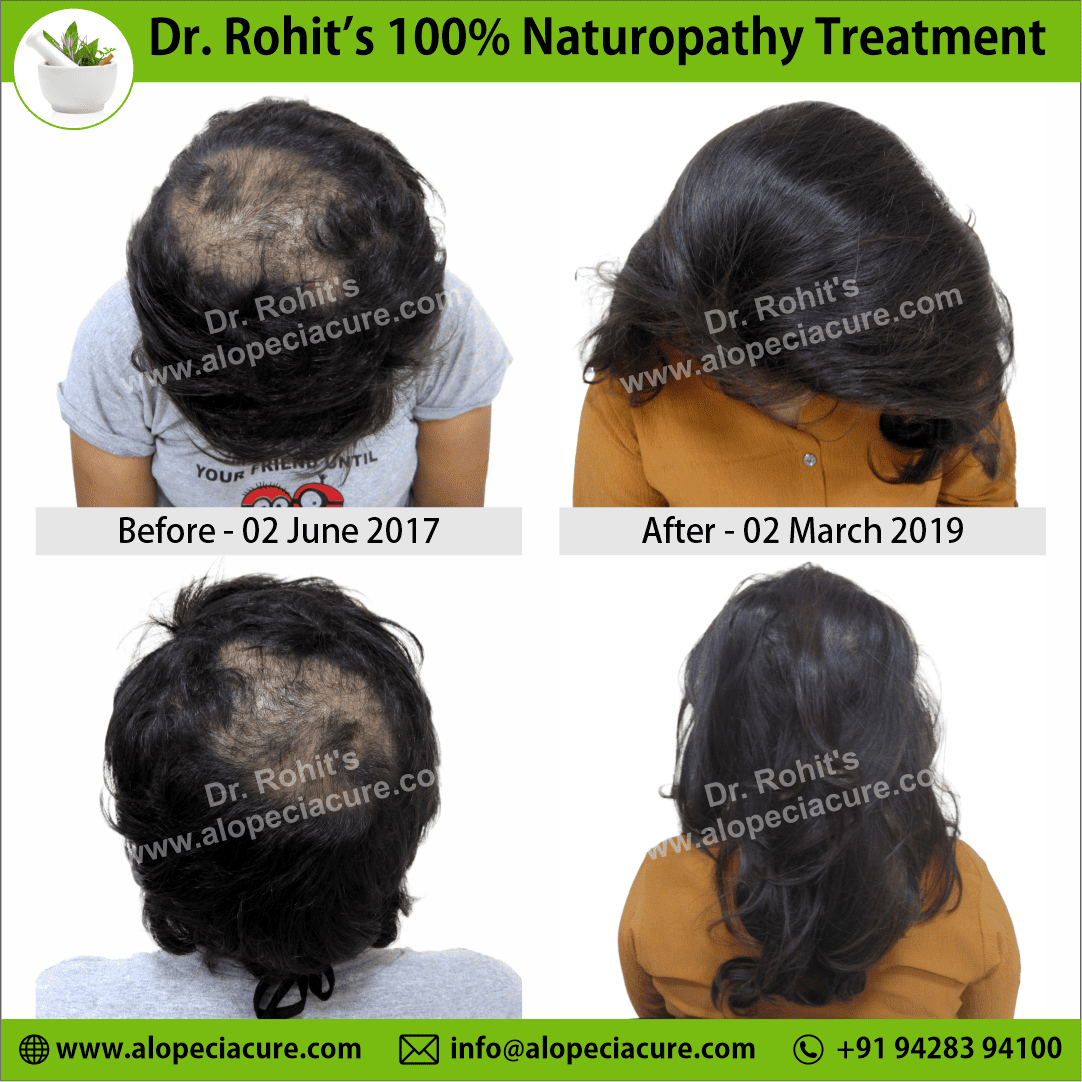 Ophiasis Alopecia Areata Clinical Result