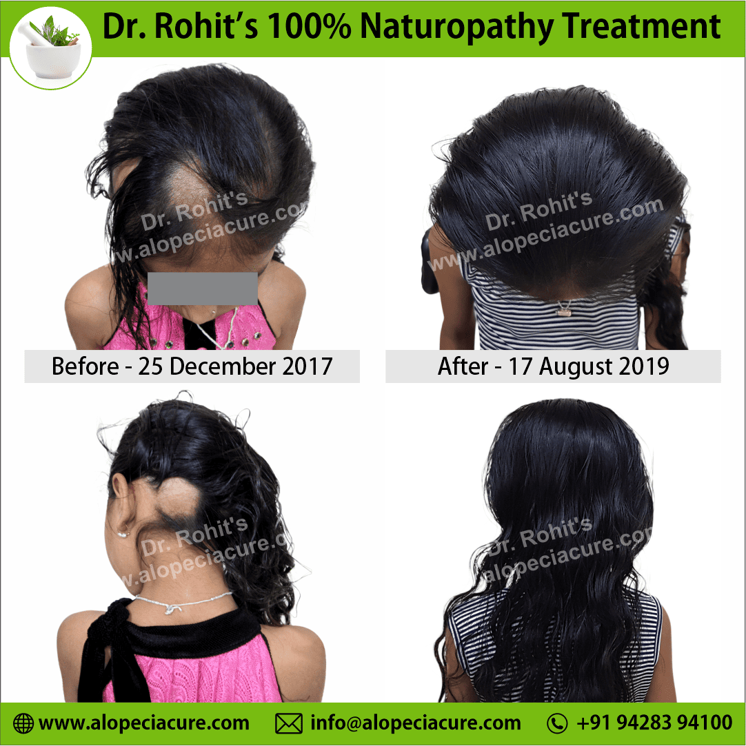 Ophiasis Alopecia Areata Clinical Result