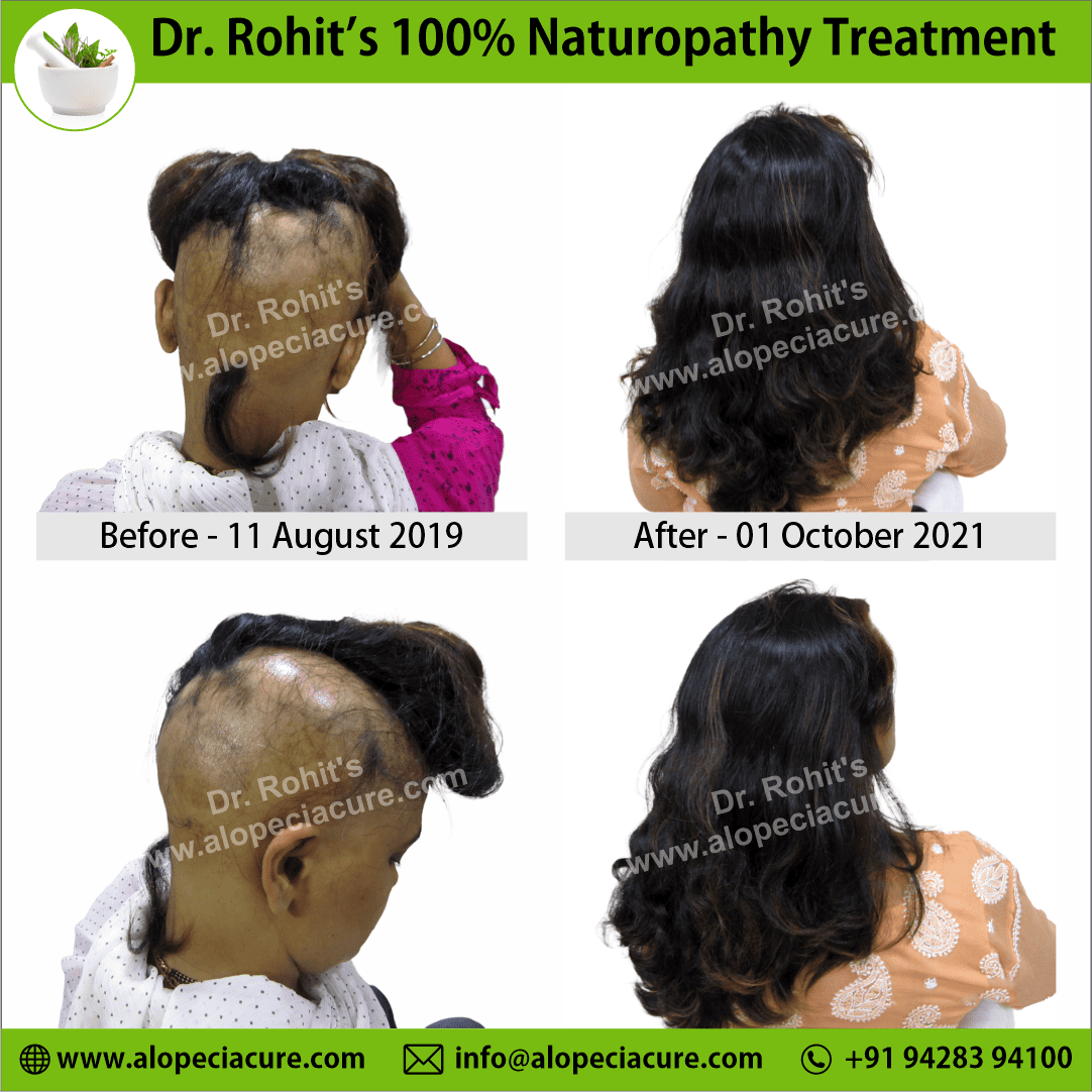 Ophiasis Alopecia Areata Clinical Result