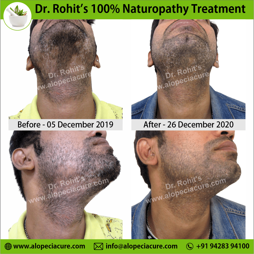 Ophiasis Alopecia Areata Clinical Result