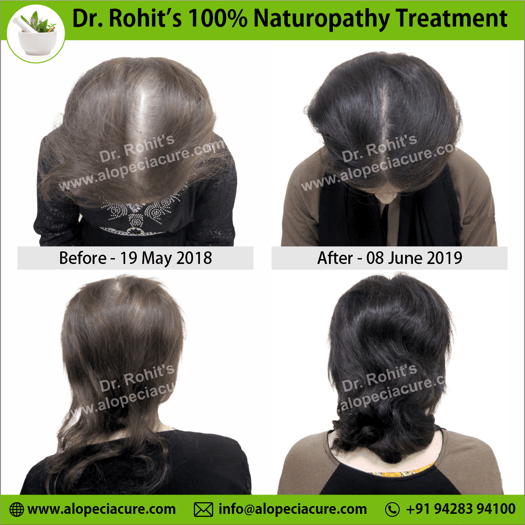Ophiasis Alopecia Areata Clinical Result