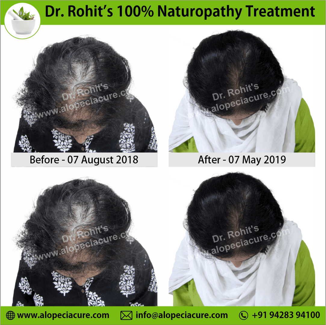 Ophiasis Alopecia Areata Clinical Result