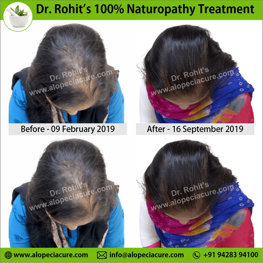 Ophiasis Alopecia Areata Clinical Result