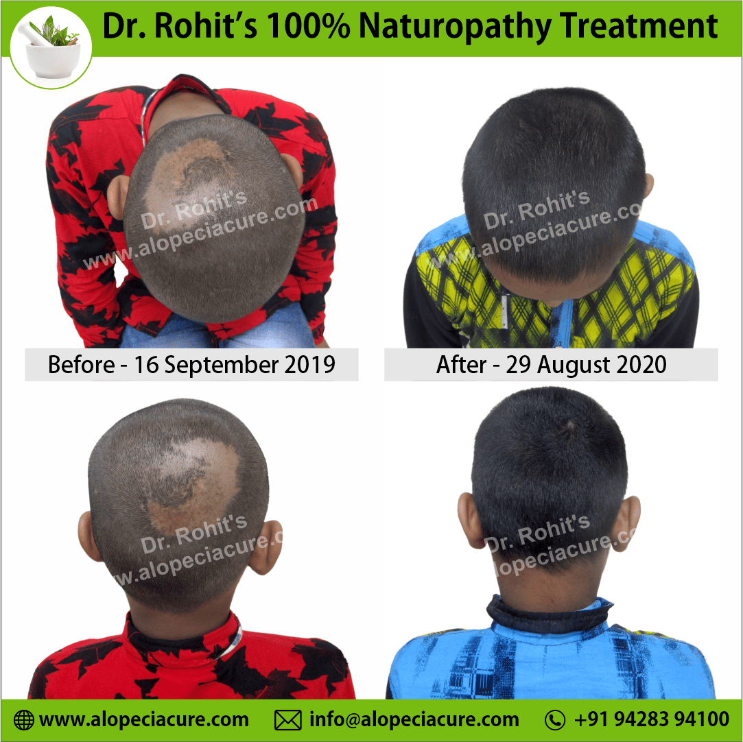 Ophiasis Alopecia Areata Clinical Result