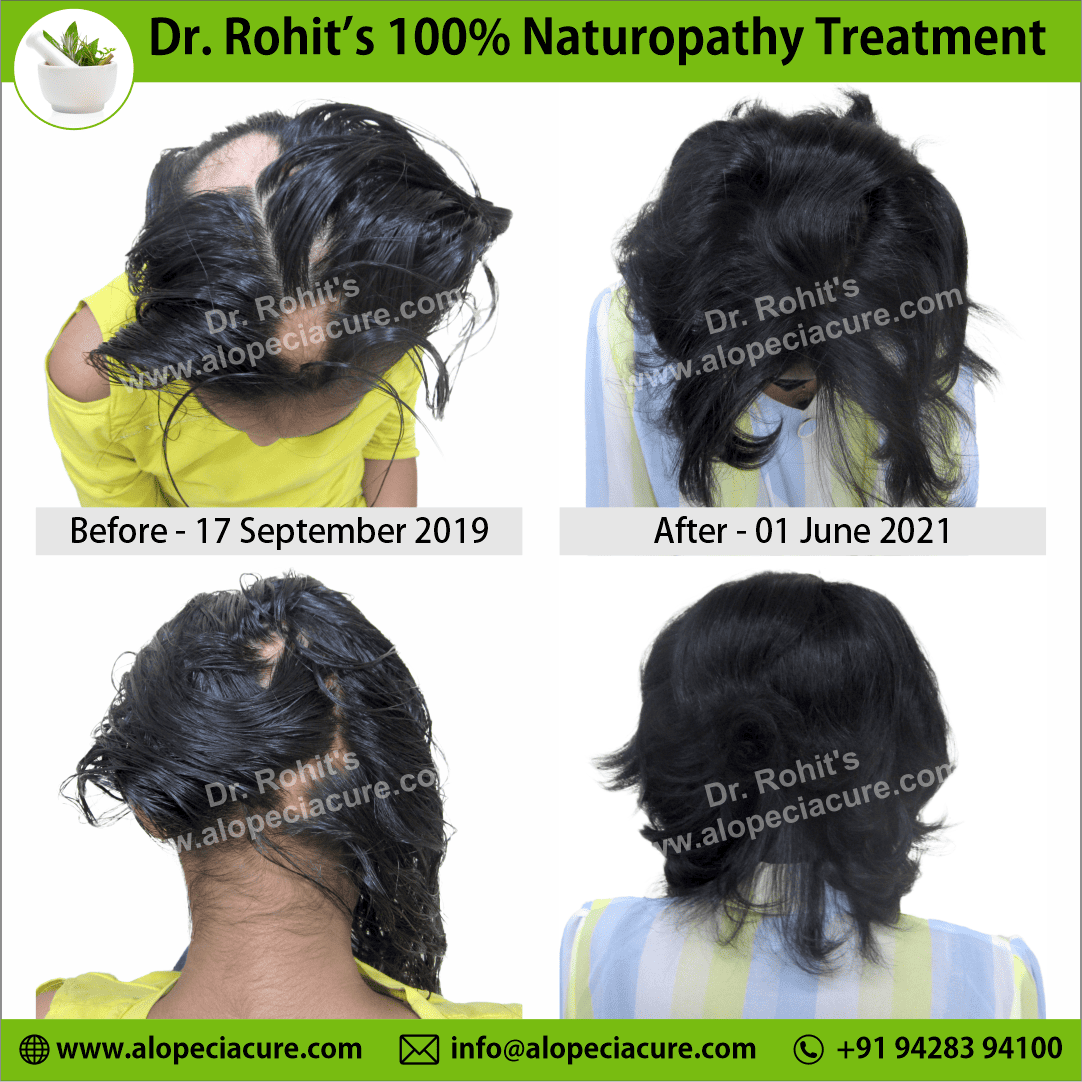 Ophiasis Alopecia Areata Clinical Result