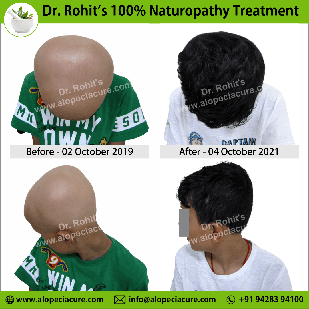 Ophiasis Alopecia Areata Clinical Result
