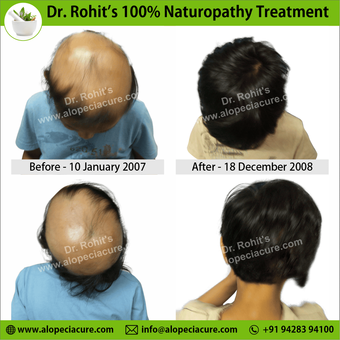 Ophiasis Alopecia Areata Clinical Result