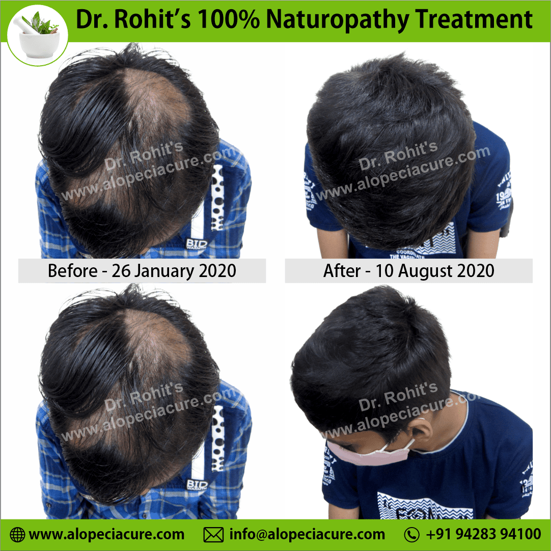 Ophiasis Alopecia Areata Clinical Result