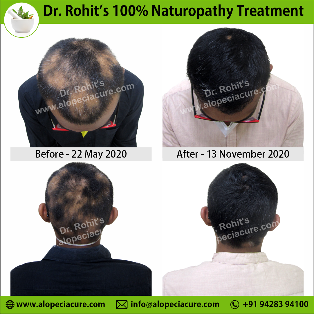 Ophiasis Alopecia Areata Clinical Result