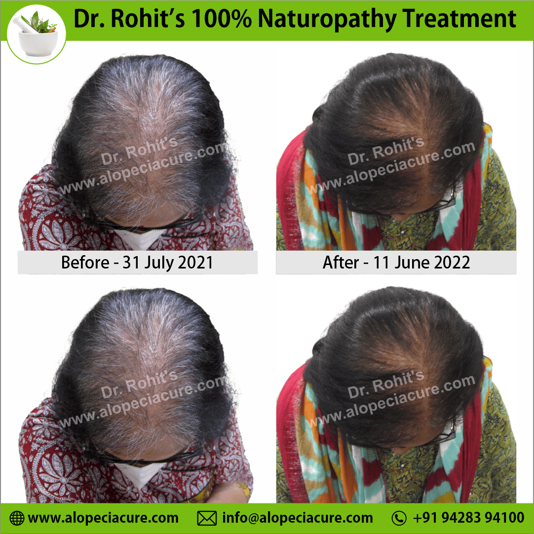 Ophiasis Alopecia Areata Clinical Result