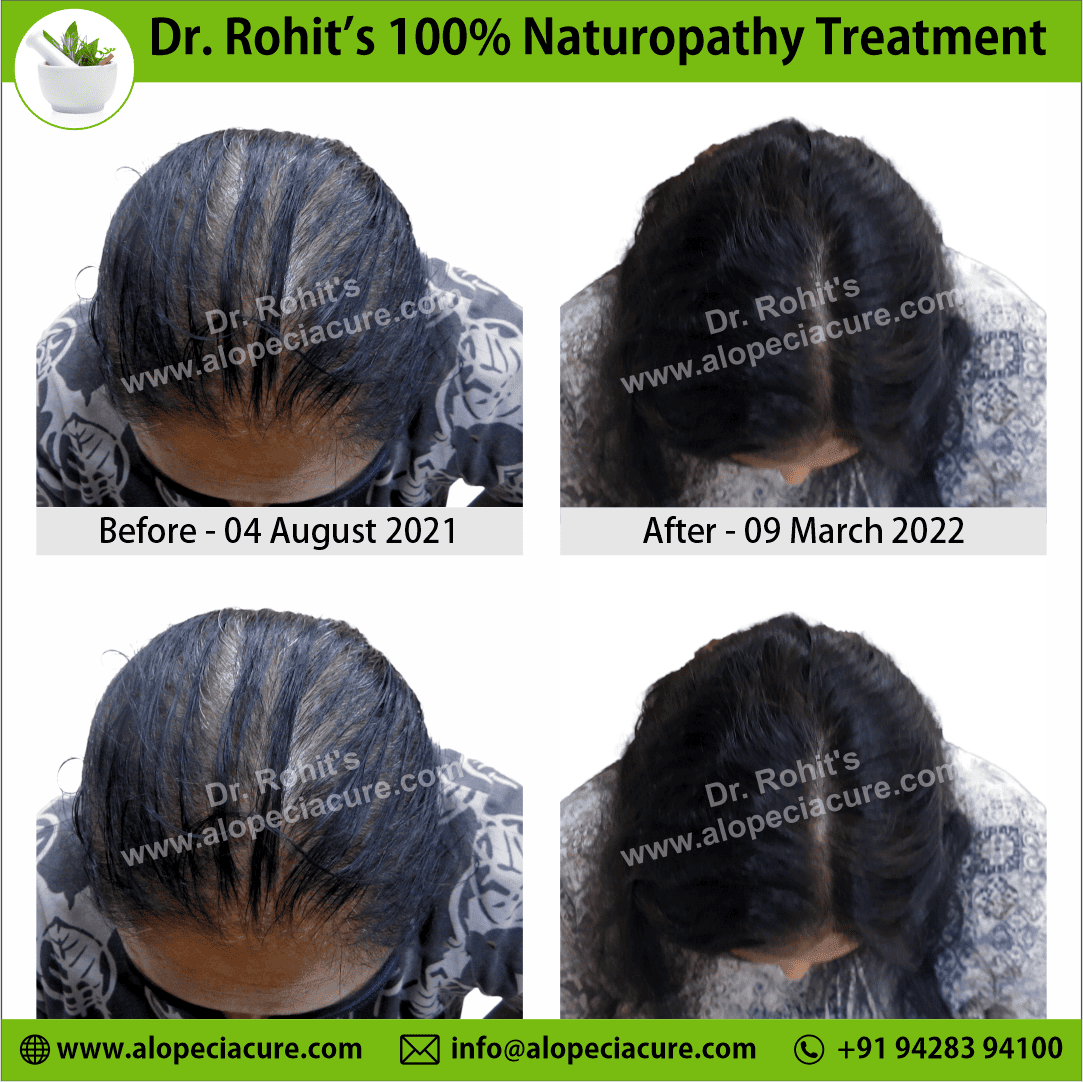 Ophiasis Alopecia Areata Clinical Result