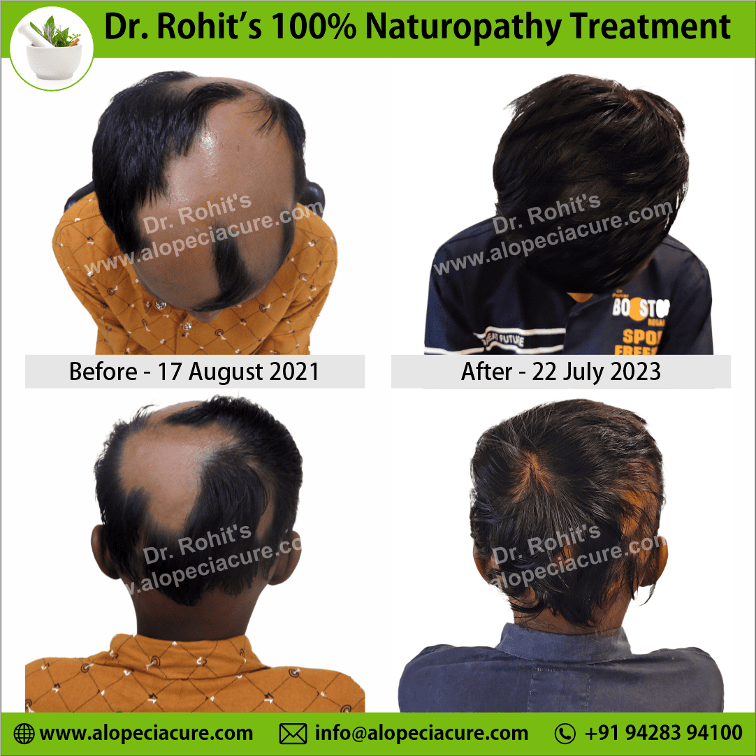 Ophiasis Alopecia Areata Clinical Result