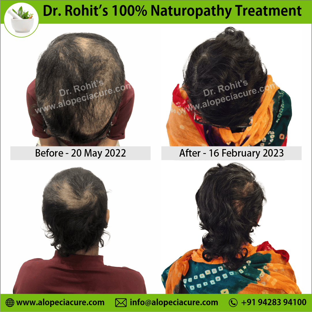 Ophiasis Alopecia Areata Clinical Result
