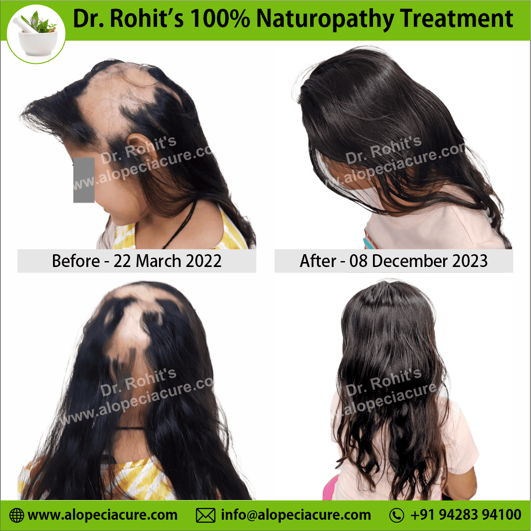 Ophiasis Alopecia Areata Clinical Result
