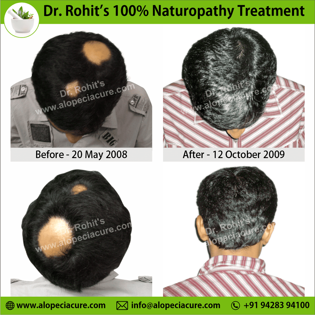 Ophiasis Alopecia Areata Clinical Result
