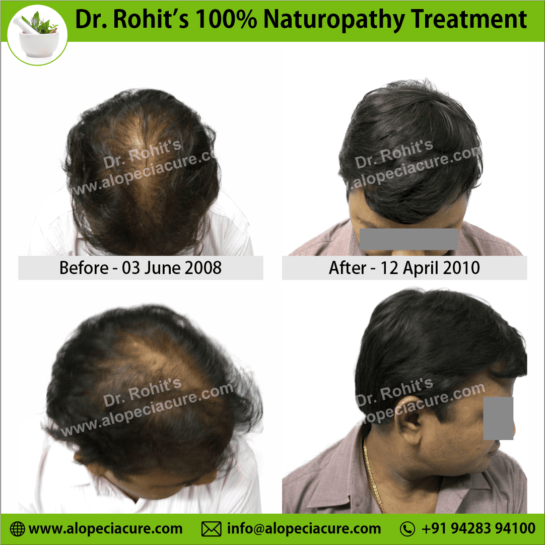 Ophiasis Alopecia Areata Clinical Result