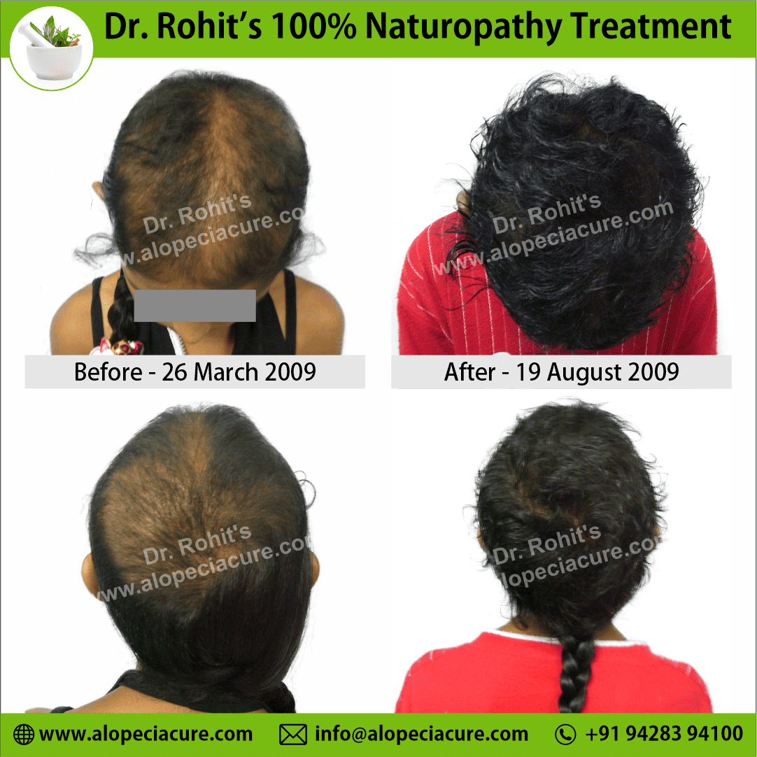 Ophiasis Alopecia Areata Clinical Result