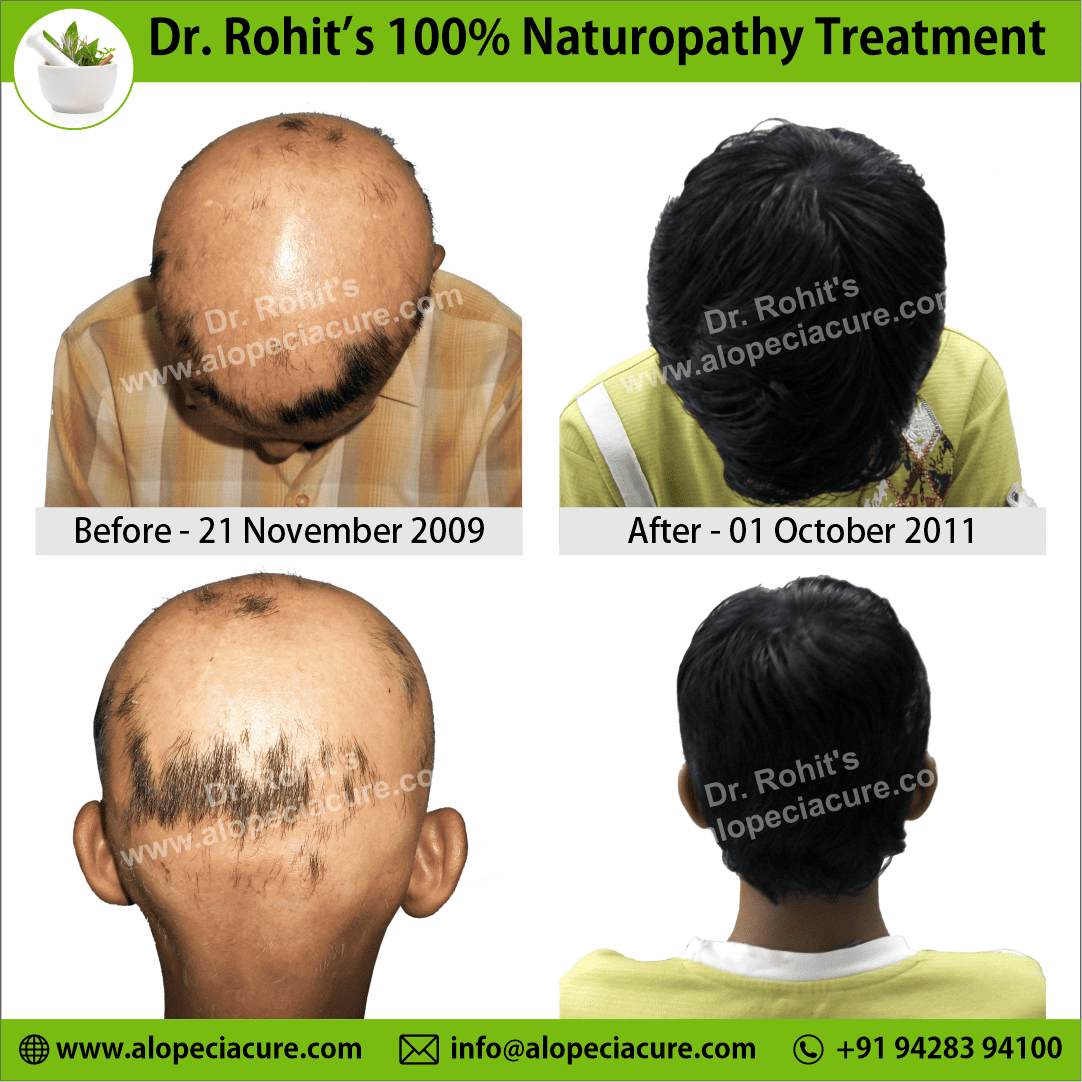 Ophiasis Alopecia Areata Clinical Result