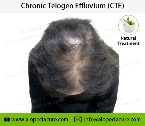 Chronic Telogen Effluvium Clinical Treatment Slide 1