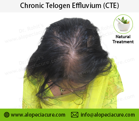 Chronic Telogen Effluvium Clinical Treatment Slide 2