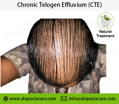Chronic Telogen Effluvium Clinical Treatment Slide 3