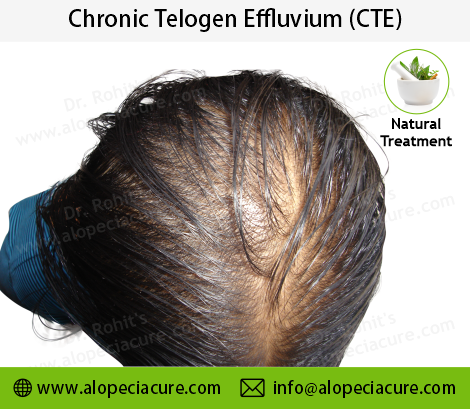 Chronic Telogen Effluvium Clinical Treatment Slide 4