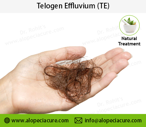 Telogen Effluvium Treatment Result 1