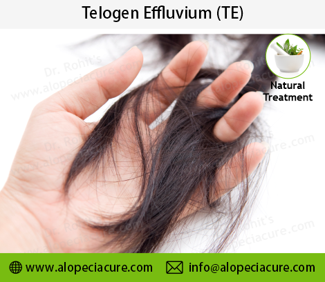 Telogen Effluvium Treatment Result 2