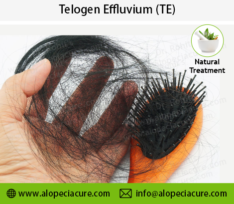 Telogen Effluvium Treatment Result 3