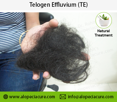 Telogen Effluvium Treatment Result 4