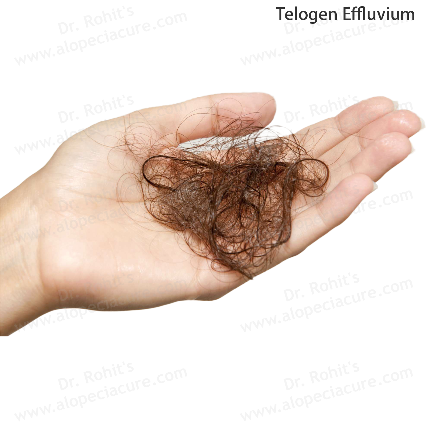 Telogen Effluvium Clinical Treatment Slide 1